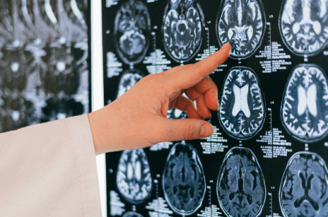 A left hand of a light-skinned person wearing a white sleeve. The pointer finger gestures to an MRI brain image. 
